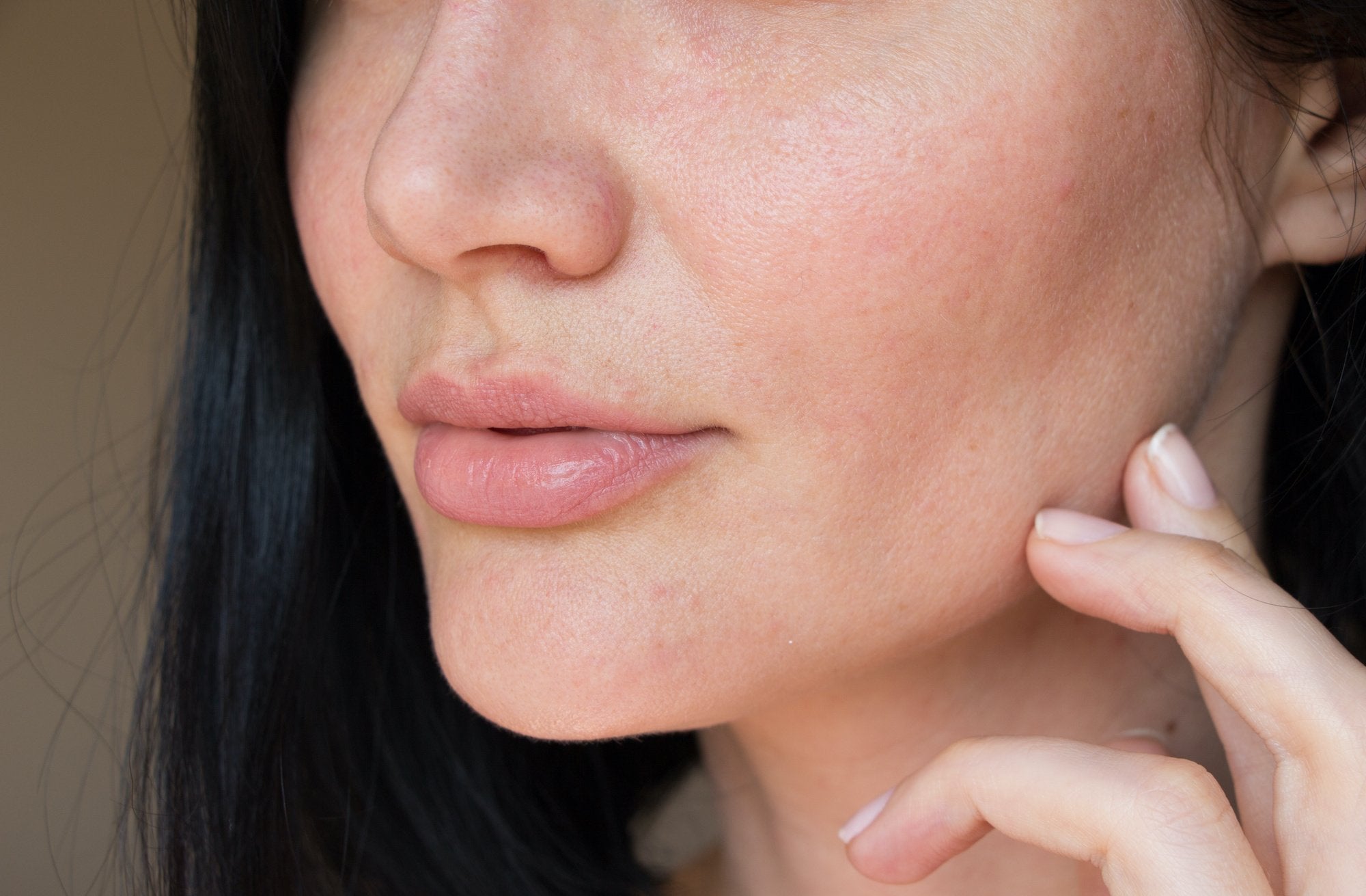 Fact or Fiction: Getting the Real Deal on Common Acne Myths
