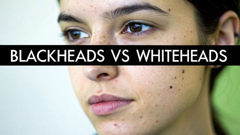 what is the difference between blackheads and whiteheads