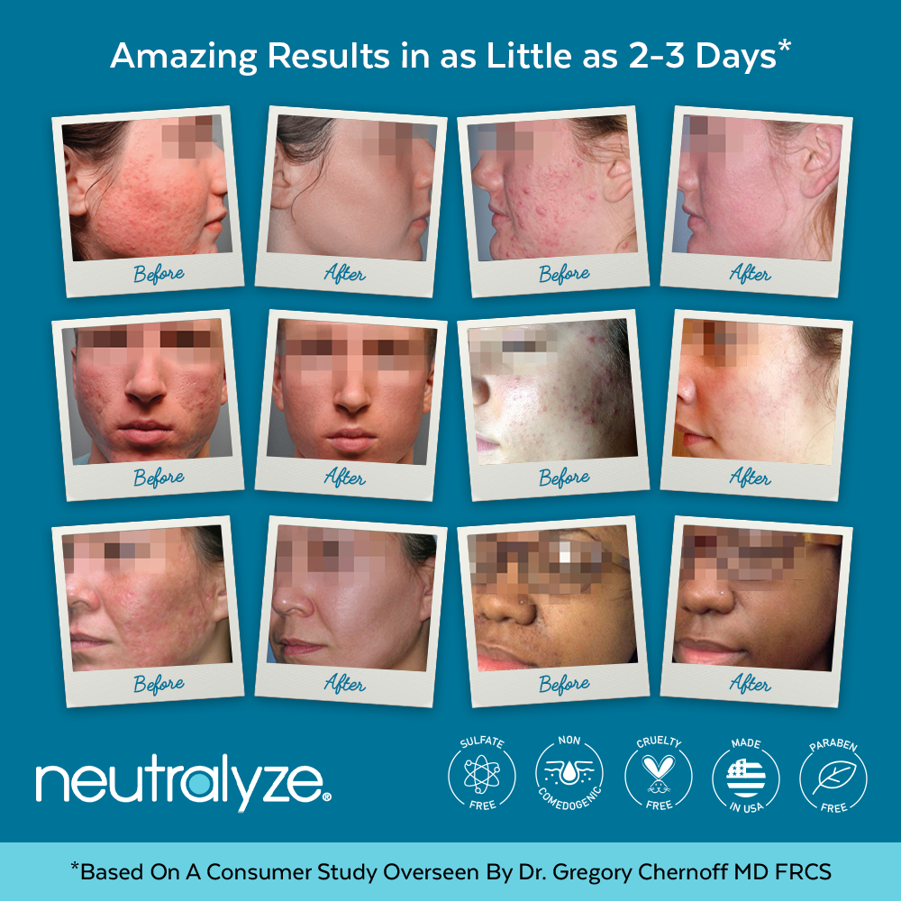 Load image into Gallery viewer, Neutralyze Moderate To Severe Acne Treatment Kit 2.0
