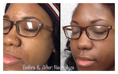 Before and after photos of a Neutralyze customer