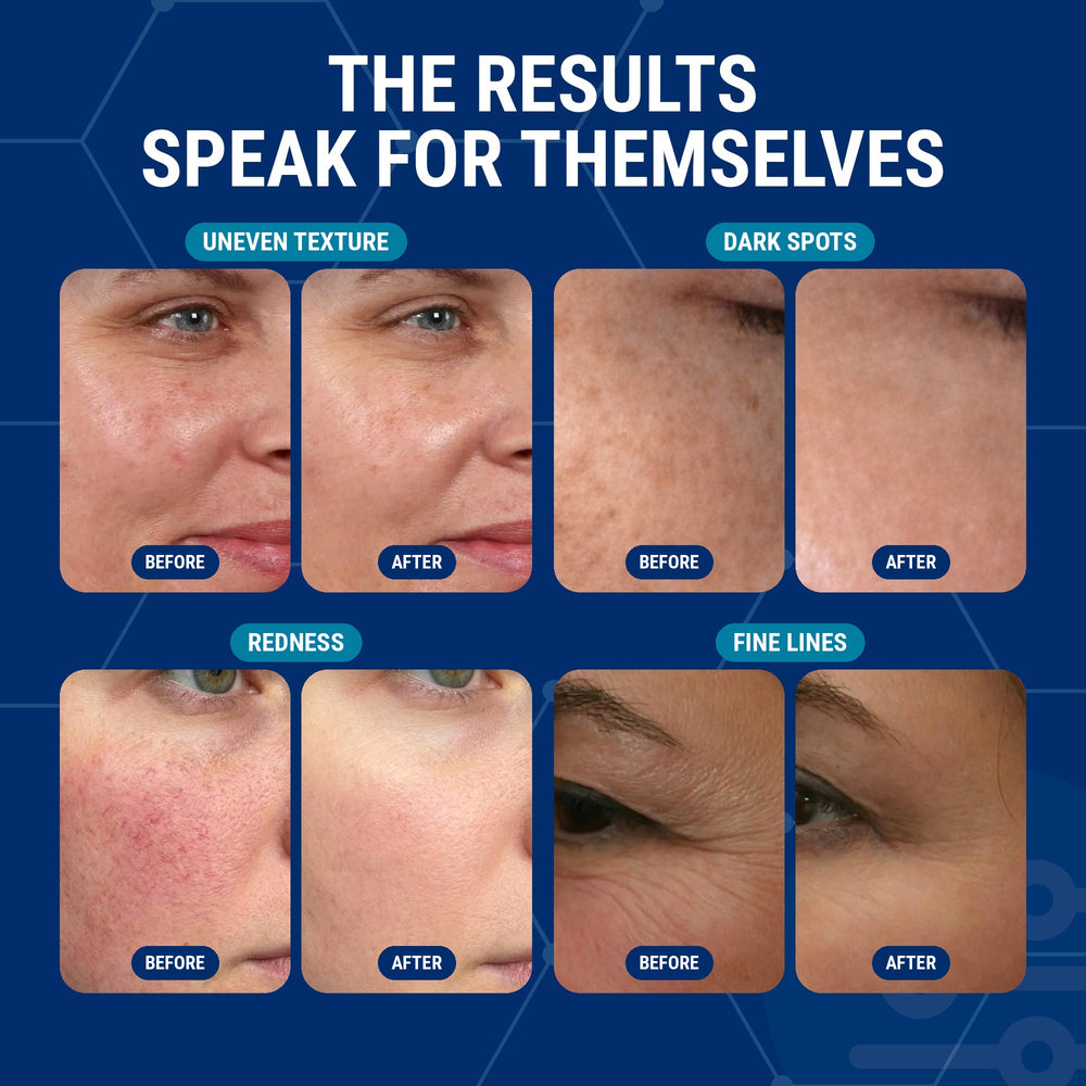 Before and after photos in a two by two grid under the headline The results speak for themselves. Panels are labeled Uneven texture, Dark spots, Redness and Fine lines.