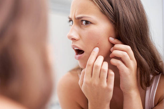 Debunking Myths on Acne Scarring