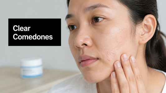 A Guide to Clearing Acne Closed Comedo and Bumps