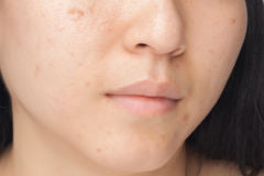 Spotting the Type of Acne You Have and How to Treat It