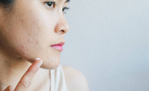 A Case Against Natural and Organic Acne Treatment