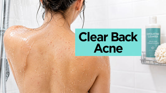 Back Acne Routine That Actually Clears Your Back