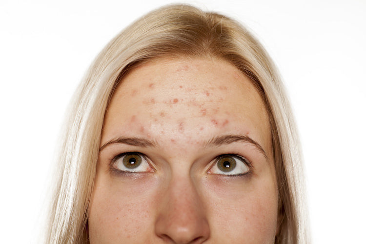 Purging vs. Breakout: Is Your New Skincare Product Working, or Is It Making Your Acne Worse?