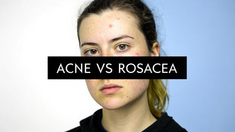 Difference between acne and rosacea: Key signs and care tips
