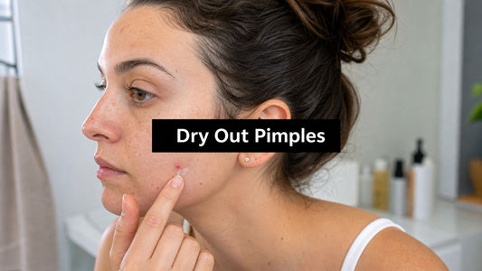 Safely Dry Out Pimples: Treat Breakouts Effectively