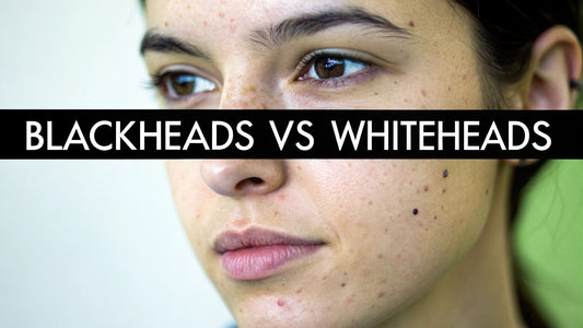 What Is the Difference Between Blackheads and Whiteheads?