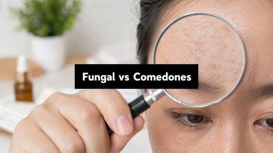 Fungal Acne vs Closed Comedones: How to Tell Them Apart