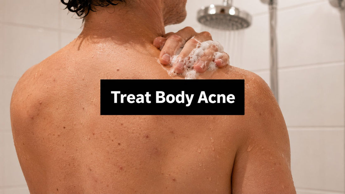 How to Treat Body Acne: A Clinically-Minded Guide That Works
