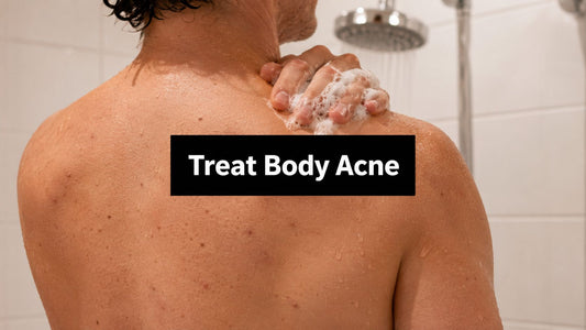 How to Treat Body Acne: A Clinically-Minded Guide That Works