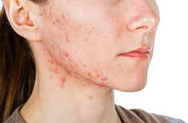 3 Effective Ways to Treat Severe Acne