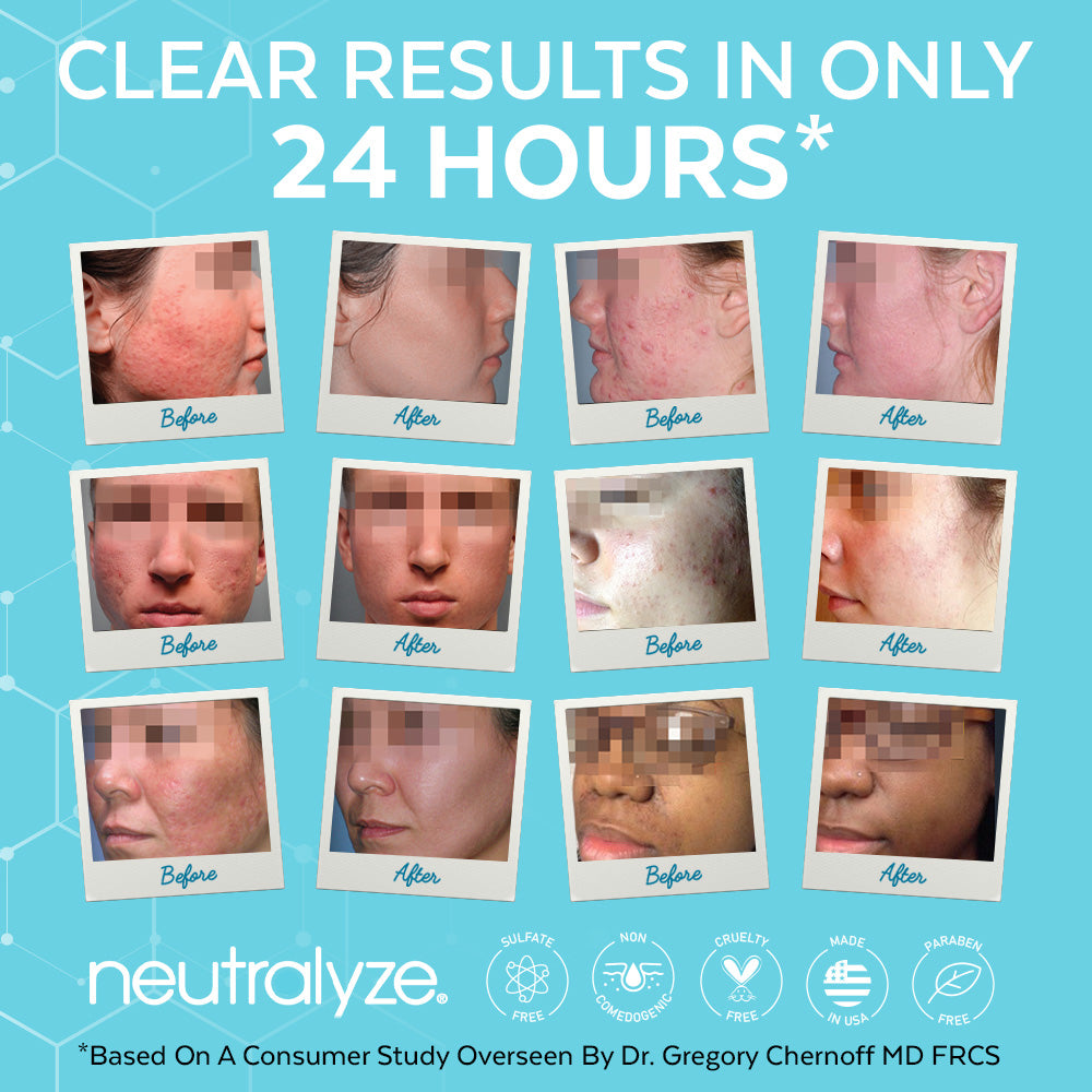 Neutralyze Moderate To Severe Acne Treatment Kit 2.0