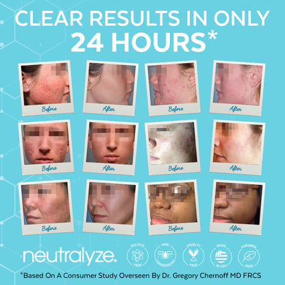 Neutralyze Moderate To Severe Acne Treatment Kit 2.0